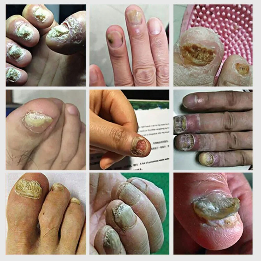 Nail Fungus Serum