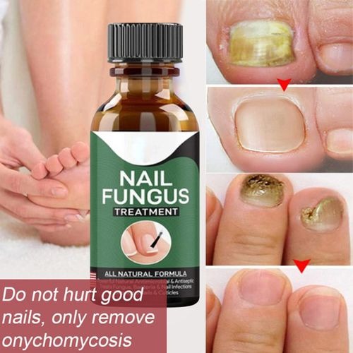 Nail Fungus Serum